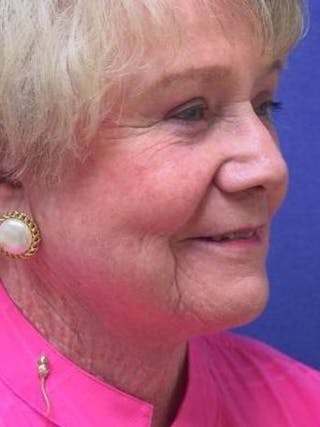 Face Lift Before & After Gallery - Patient 331383 - Image 4