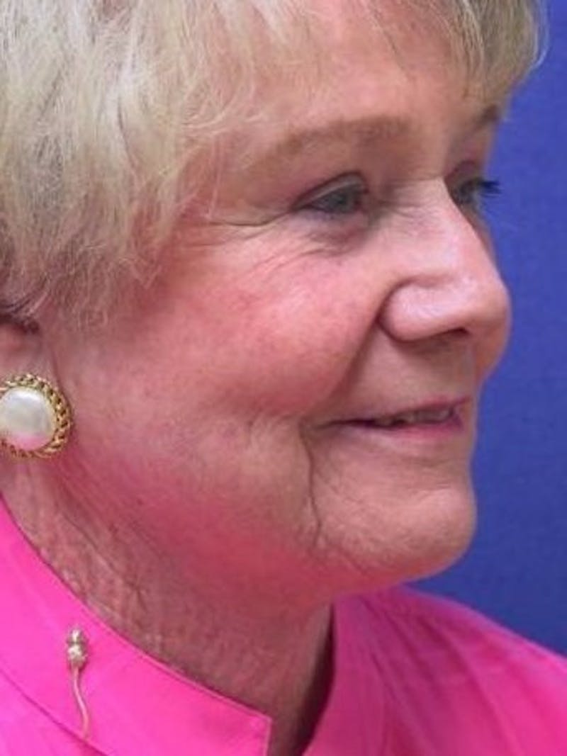 Face Lift Before & After Gallery - Patient 331383 - Image 4