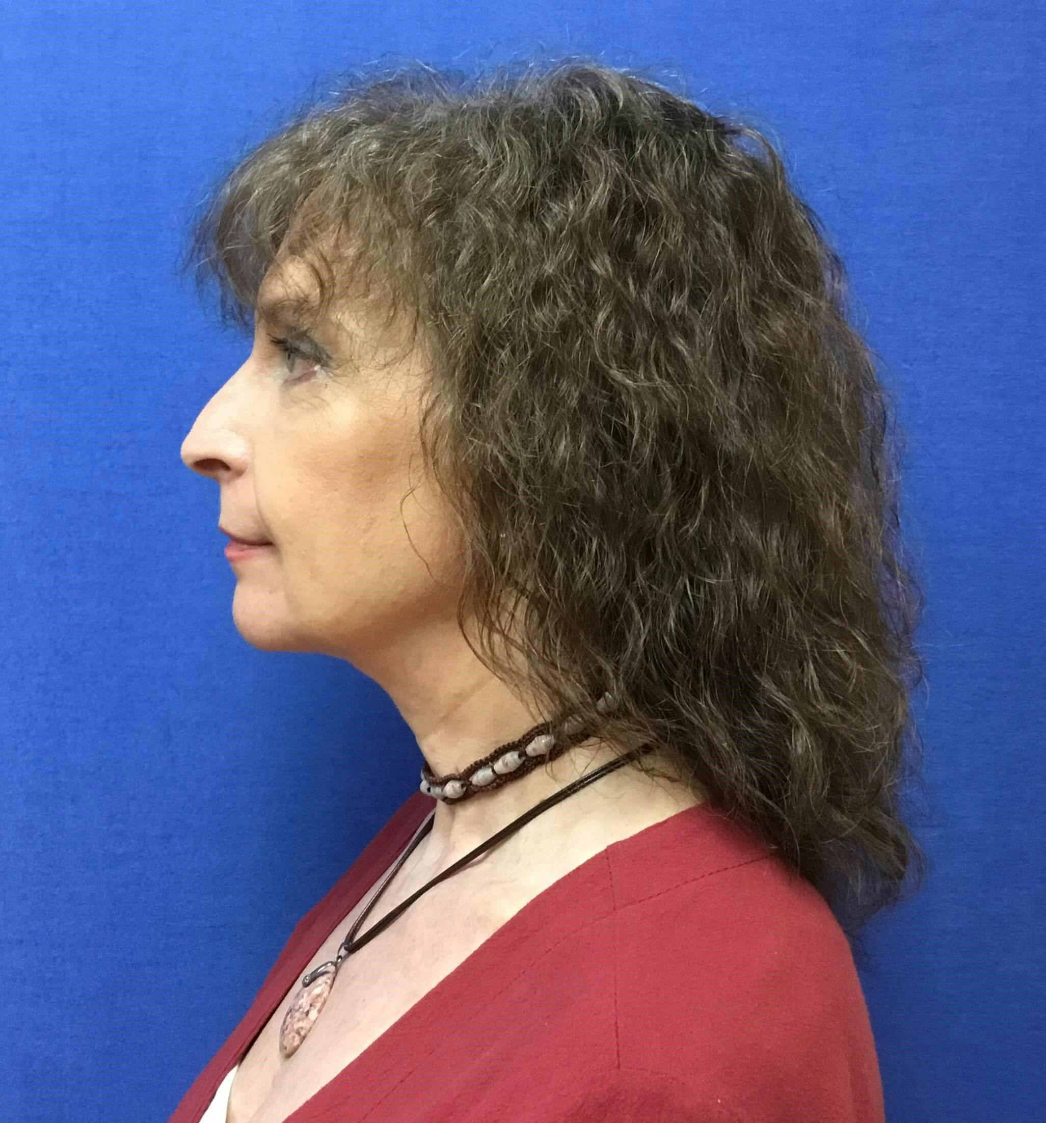 Neck Liposuction Before & After Gallery - Patient 202364 - Image 2