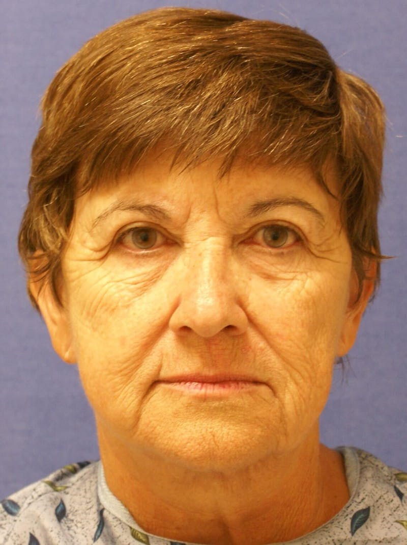 Laser Skin Resurfacing Before & After Gallery - Patient 417855 - Image 1
