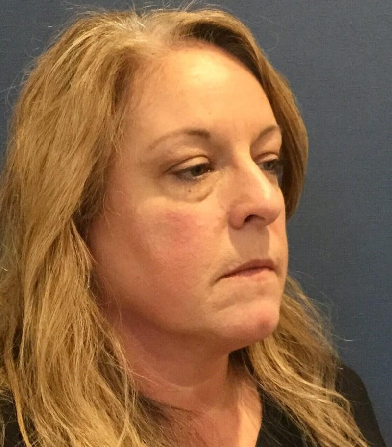 Eyelid Surgery Before & After Gallery - Patient 285354 - Image 3