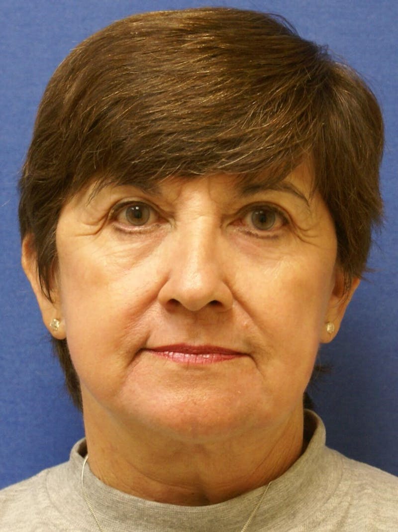 Laser Skin Resurfacing Before & After Gallery - Patient 417855 - Image 2