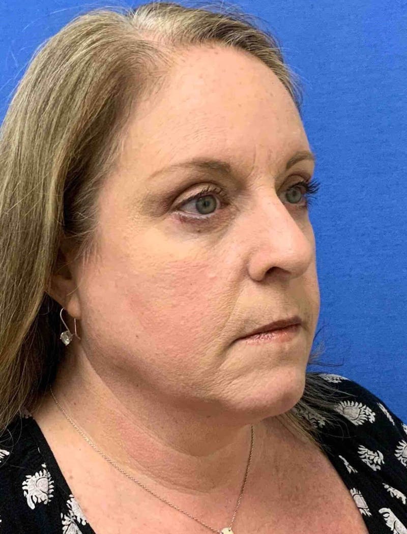 Eyelid Surgery Before & After Gallery - Patient 285354 - Image 4