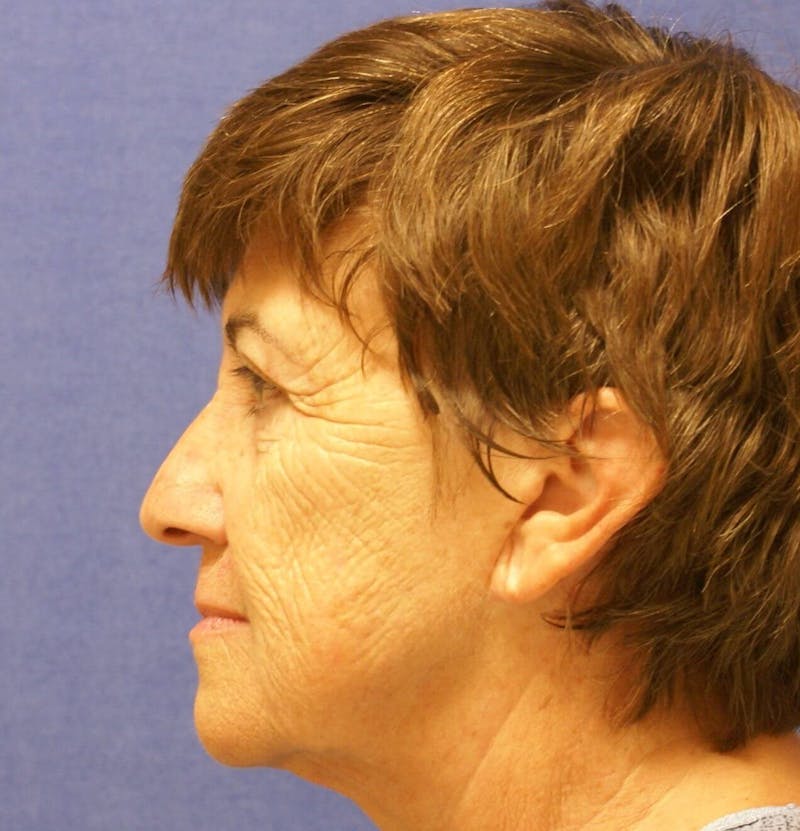 Laser Skin Resurfacing Before & After Gallery - Patient 417855 - Image 3