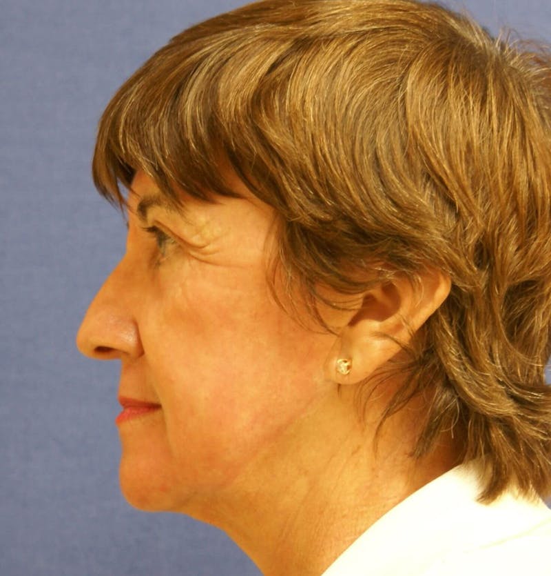Laser Skin Resurfacing Before & After Gallery - Patient 417855 - Image 4
