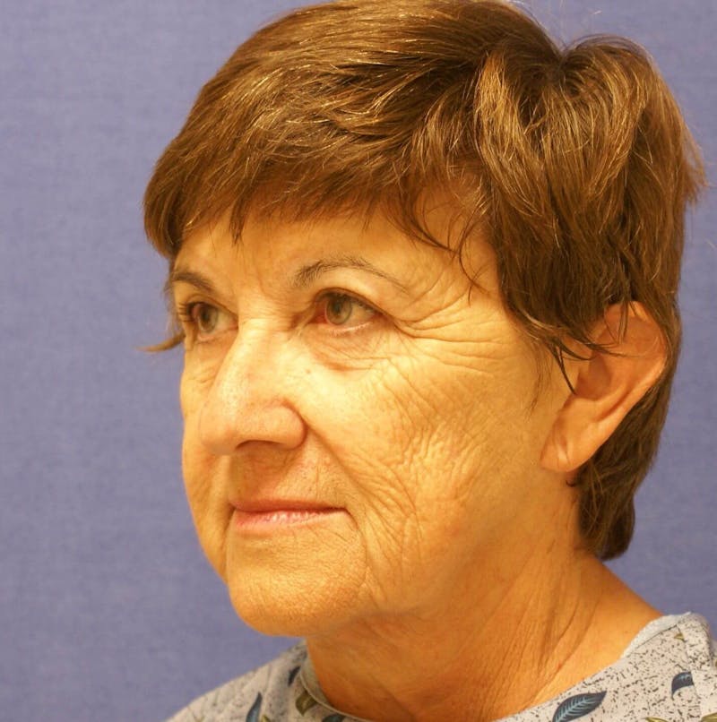 Laser Skin Resurfacing Before & After Gallery - Patient 417855 - Image 5