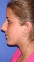 Rhinoplasty Before & After Gallery - Patient 123190 - Image 1