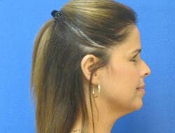 Neck Liposuction Before & After Gallery - Patient 118901 - Image 1