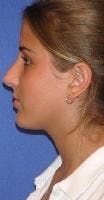 Rhinoplasty Before & After Gallery - Patient 123190 - Image 2