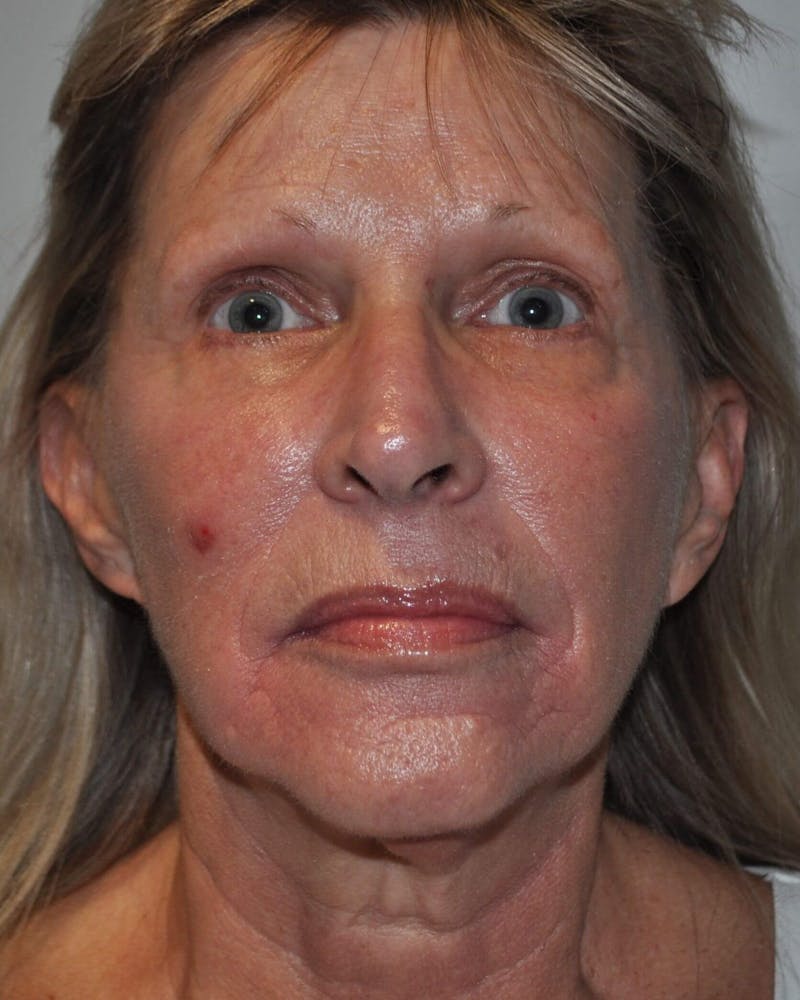 Laser Skin Resurfacing Before & After Gallery - Patient 725252 - Image 1