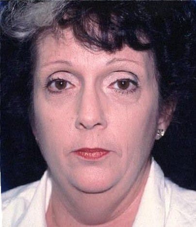 Face Lift Before & After Gallery - Patient 312191 - Image 1