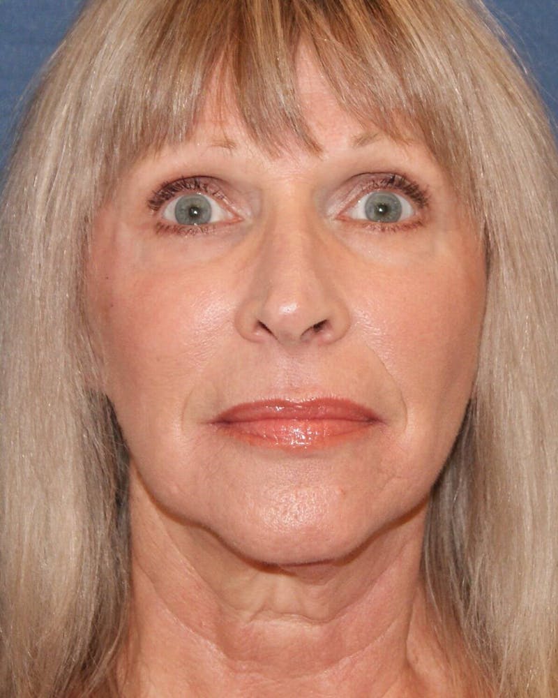 Laser Skin Resurfacing Before & After Gallery - Patient 725252 - Image 2