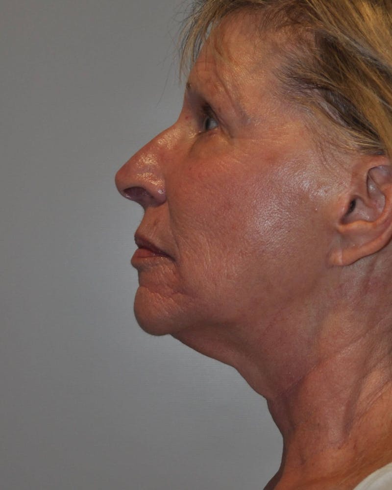 Laser Skin Resurfacing Before & After Gallery - Patient 725252 - Image 3