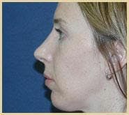 Rhinoplasty Before & After Gallery - Patient 472483 - Image 2