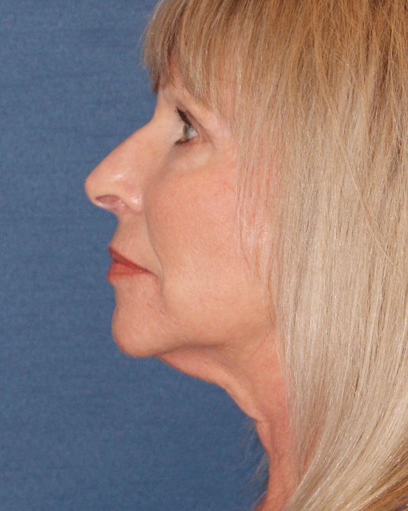 Laser Skin Resurfacing Before & After Gallery - Patient 725252 - Image 4