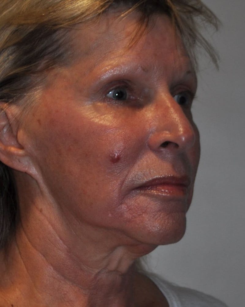 Laser Skin Resurfacing Before & After Gallery - Patient 725252 - Image 5