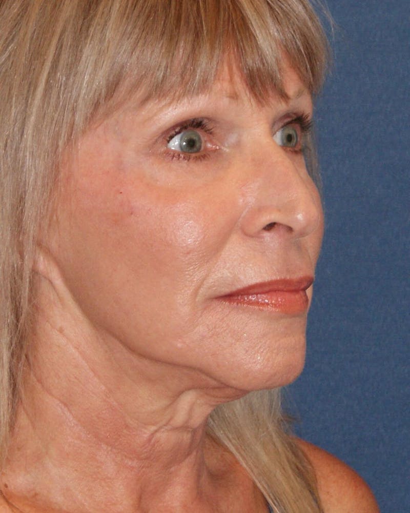 Laser Skin Resurfacing Before & After Gallery - Patient 725252 - Image 6