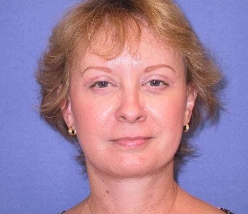 Face Lift Before & After Gallery - Patient 246004 - Image 2