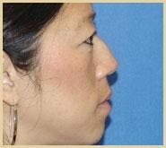 Rhinoplasty Before & After Gallery - Patient 306110 - Image 1