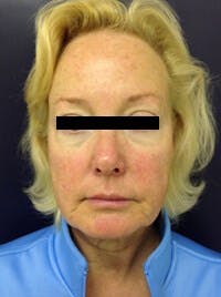 Laser Skin Resurfacing Before & After Gallery - Patient 560605 - Image 1