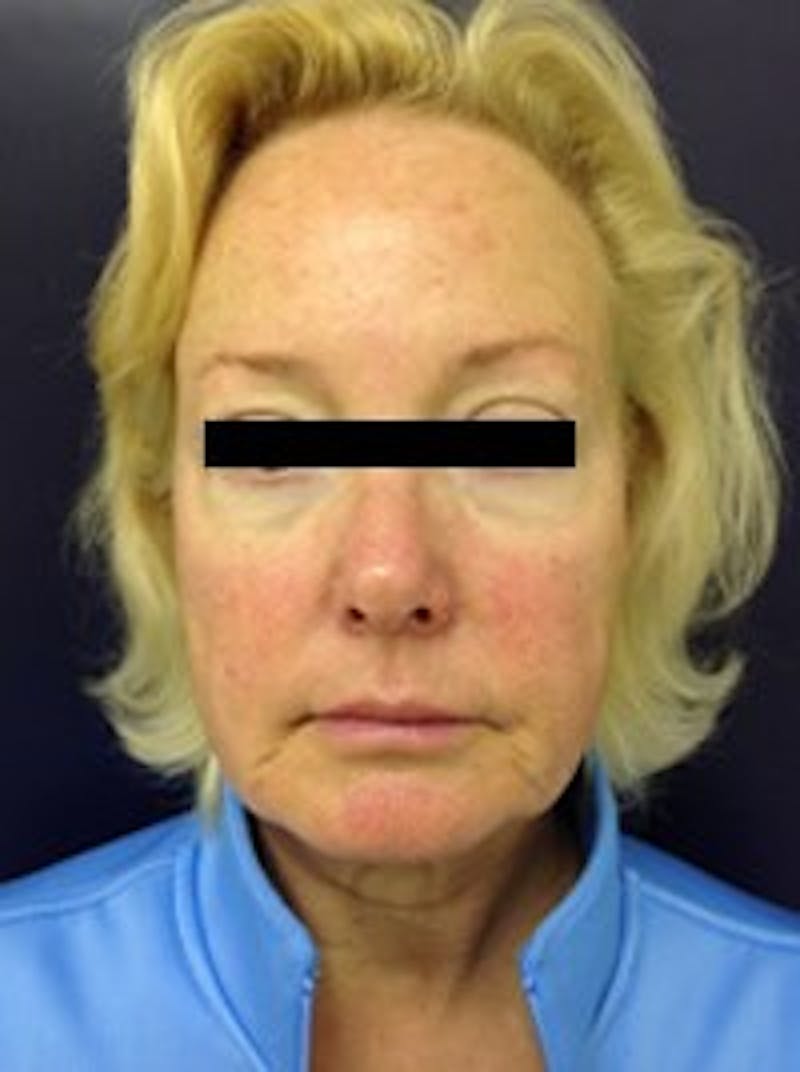 Laser Skin Resurfacing Before & After Gallery - Patient 560605 - Image 1