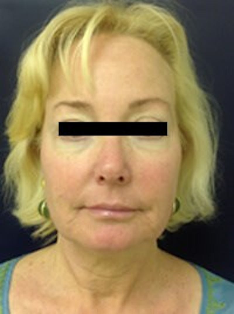 Laser Skin Resurfacing Before & After Gallery - Patient 560605 - Image 2
