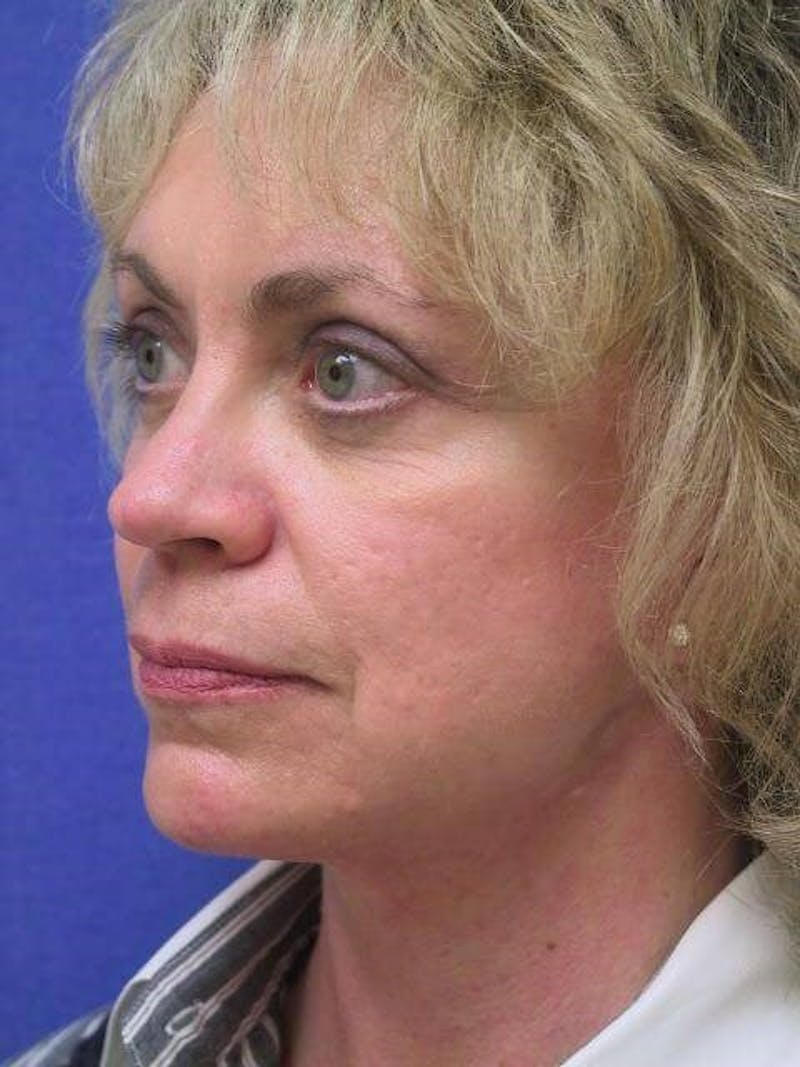 Neck Lift Before & After Gallery - Patient 273573 - Image 4