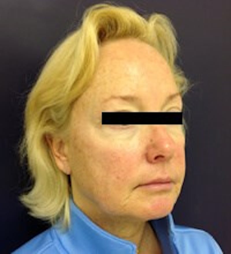 Laser Skin Resurfacing Before & After Gallery - Patient 560605 - Image 3