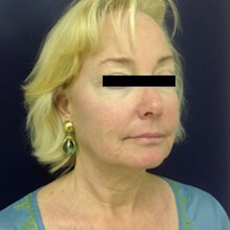 Laser Skin Resurfacing Before & After Gallery - Patient 560605 - Image 4