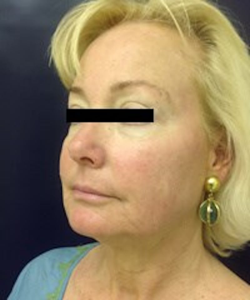 Laser Skin Resurfacing Before & After Gallery - Patient 560605 - Image 6