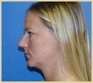 Rhinoplasty Before & After Gallery - Patient 317172 - Image 1