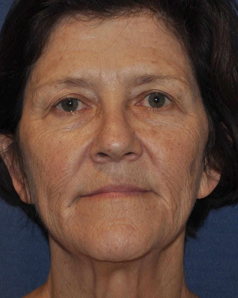 Laser Skin Resurfacing Before & After Gallery - Patient 248370 - Image 1