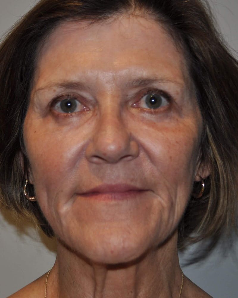 Laser Skin Resurfacing Before & After Gallery - Patient 248370 - Image 2