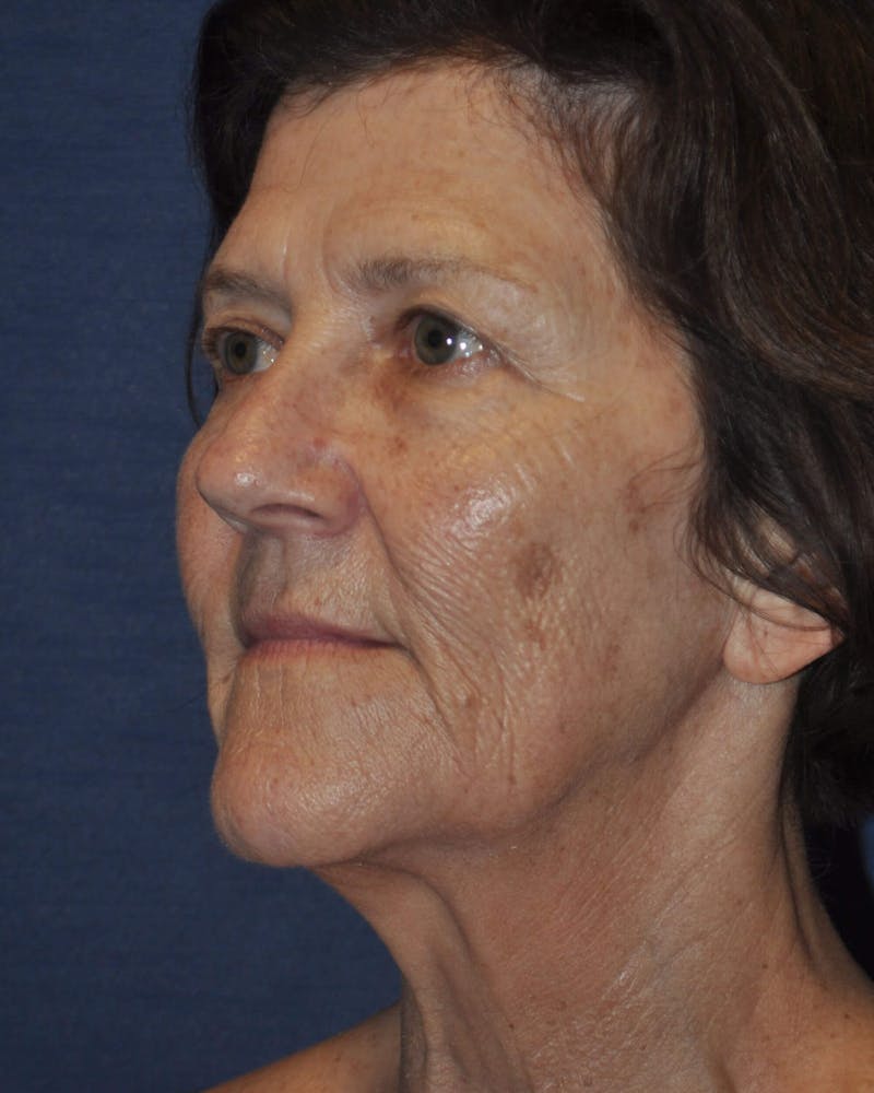 Laser Skin Resurfacing Before & After Gallery - Patient 248370 - Image 3