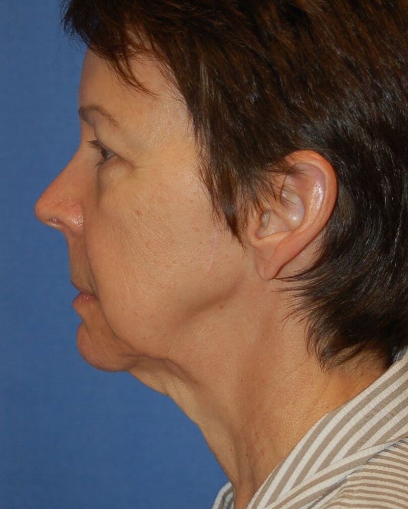 Face Lift Before & After Gallery - Patient 137864 - Image 5