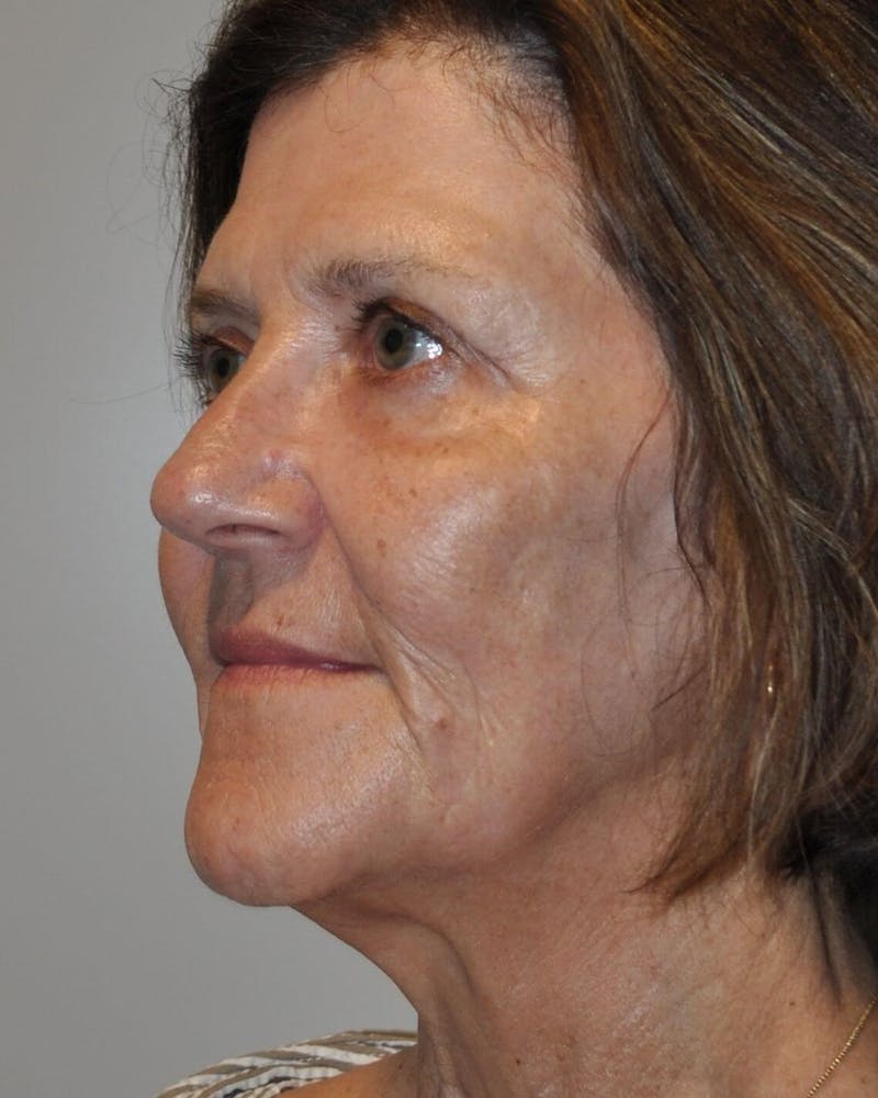 Laser Skin Resurfacing Before & After Gallery - Patient 248370 - Image 4