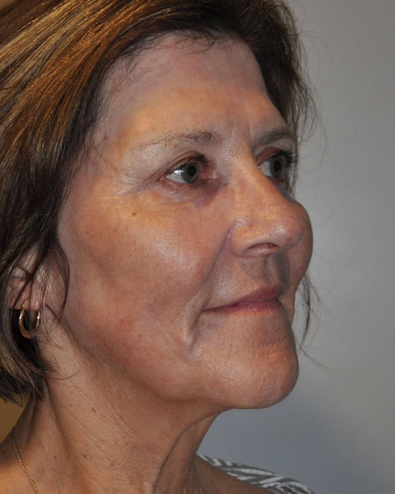 Laser Skin Resurfacing Before & After Gallery - Patient 248370 - Image 6
