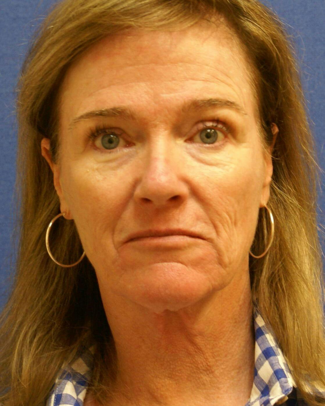Laser Skin Resurfacing Before & After Gallery - Patient 201652 - Image 1