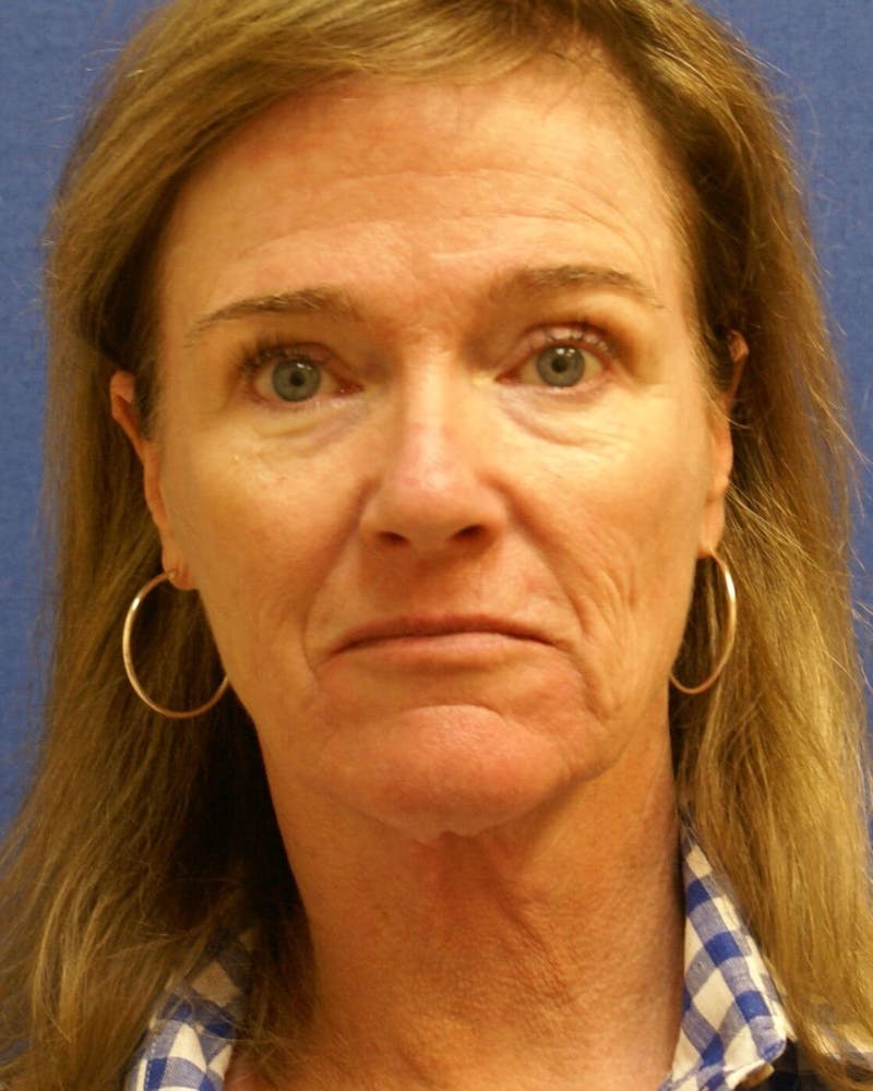 Laser Skin Resurfacing Before & After Gallery - Patient 201652 - Image 1