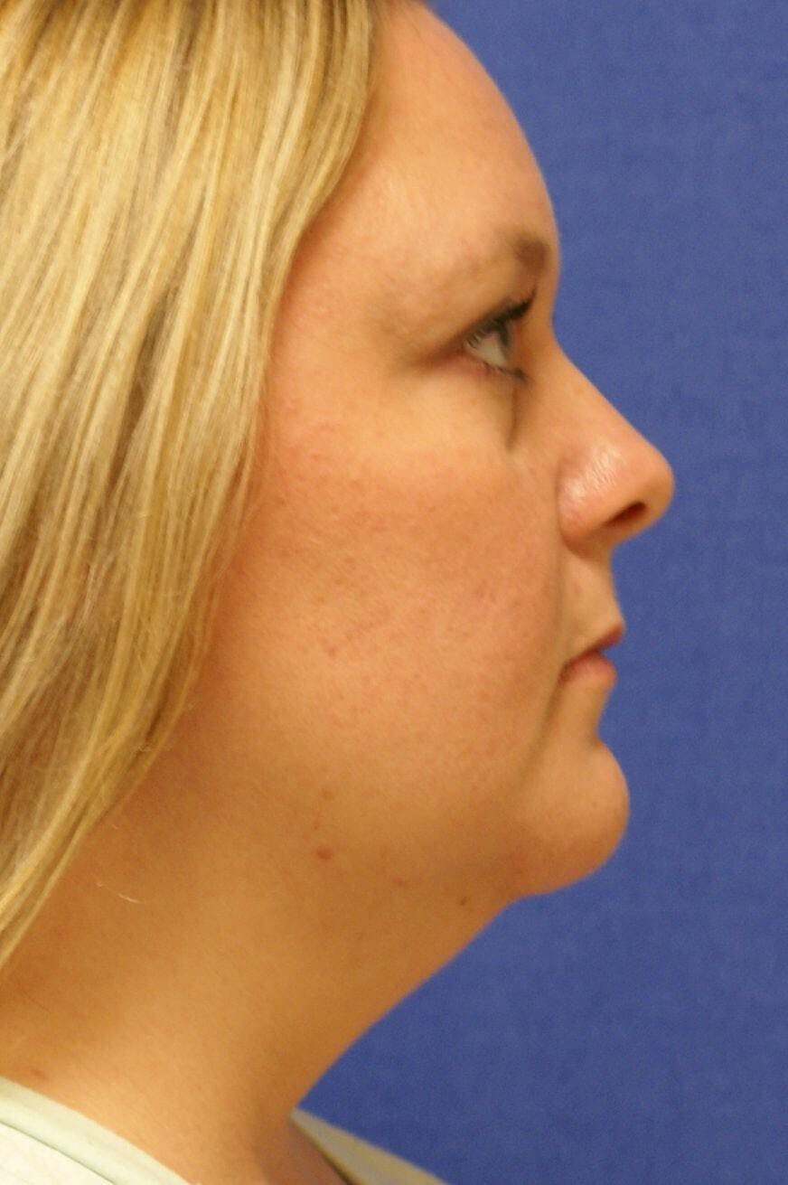 Neck Liposuction Before & After Gallery - Patient 241935 - Image 1