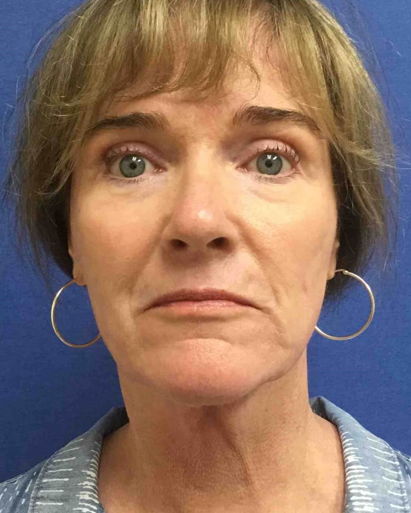Laser Skin Resurfacing Before & After Gallery - Patient 201652 - Image 2
