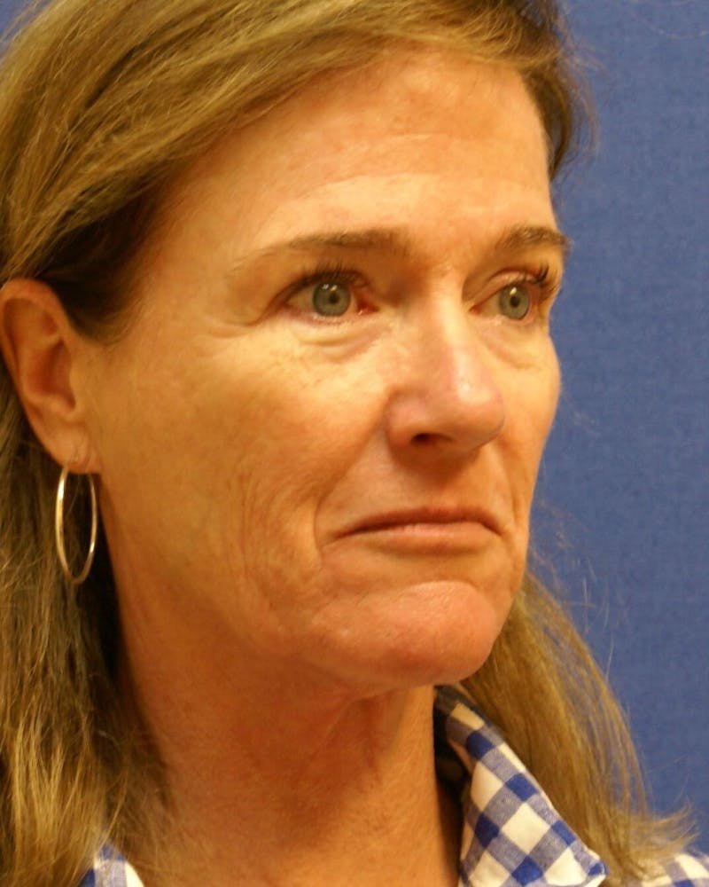 Laser Skin Resurfacing Before & After Gallery - Patient 201652 - Image 3