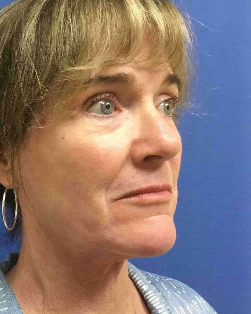 Laser Skin Resurfacing Before & After Gallery - Patient 201652 - Image 4