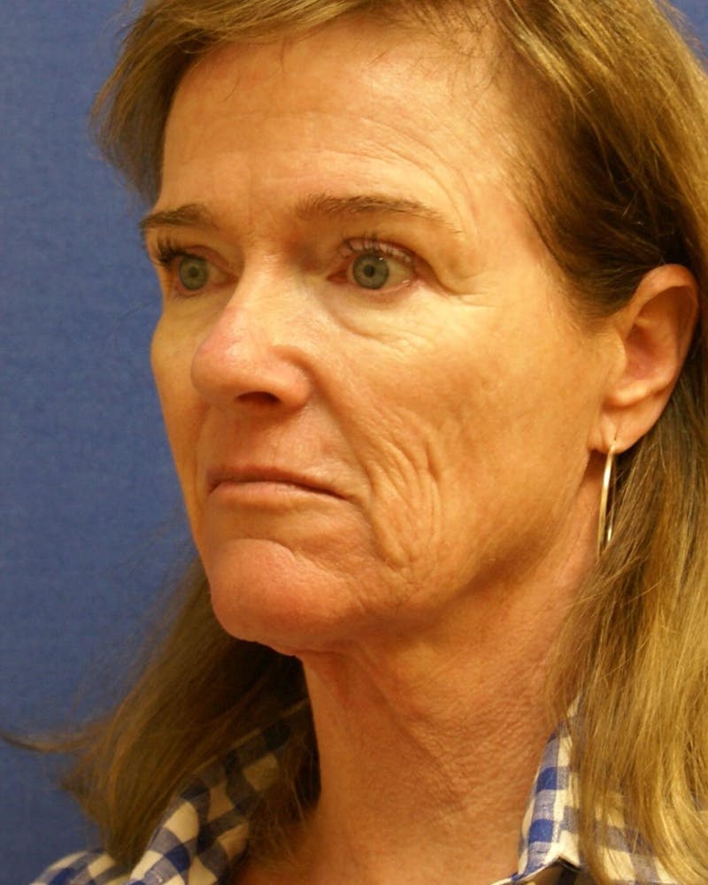 Laser Skin Resurfacing Before & After Gallery - Patient 201652 - Image 5