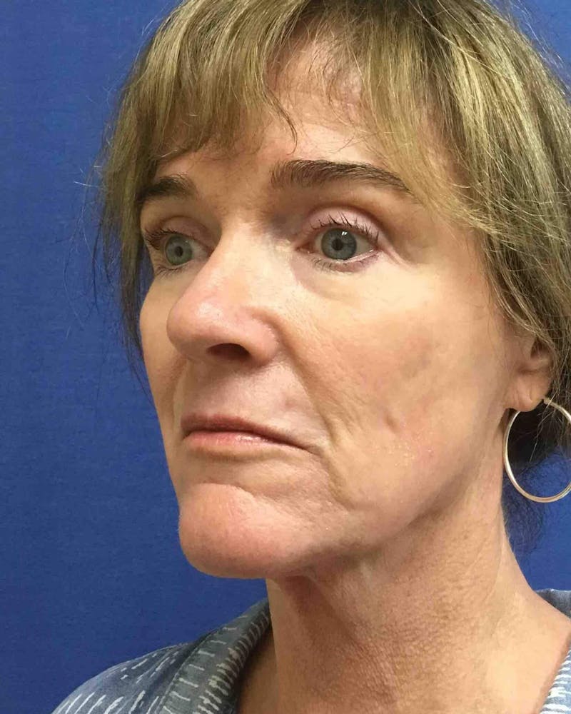 Laser Skin Resurfacing Before & After Gallery - Patient 201652 - Image 6