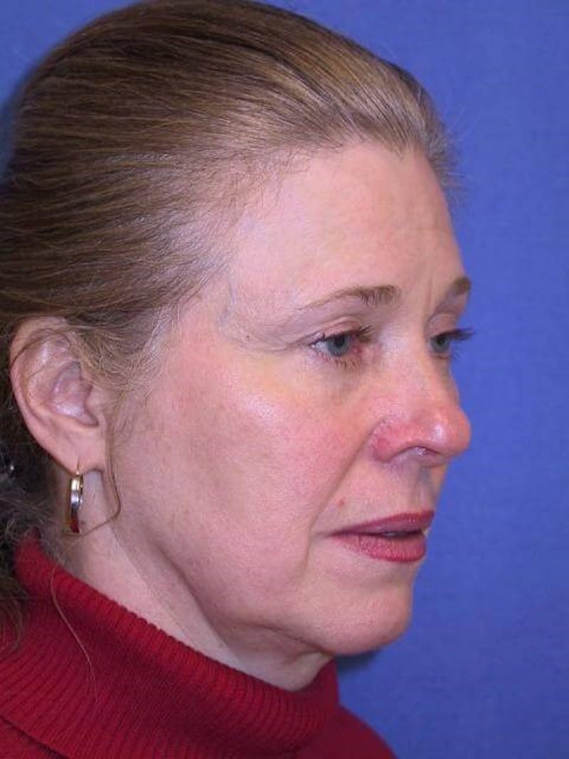 Neck Lift Before & After Gallery - Patient 419957 - Image 3