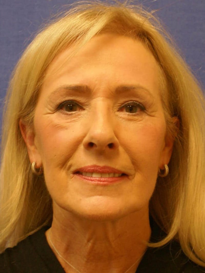 Laser Skin Resurfacing Before & After Gallery - Patient 185936 - Image 2