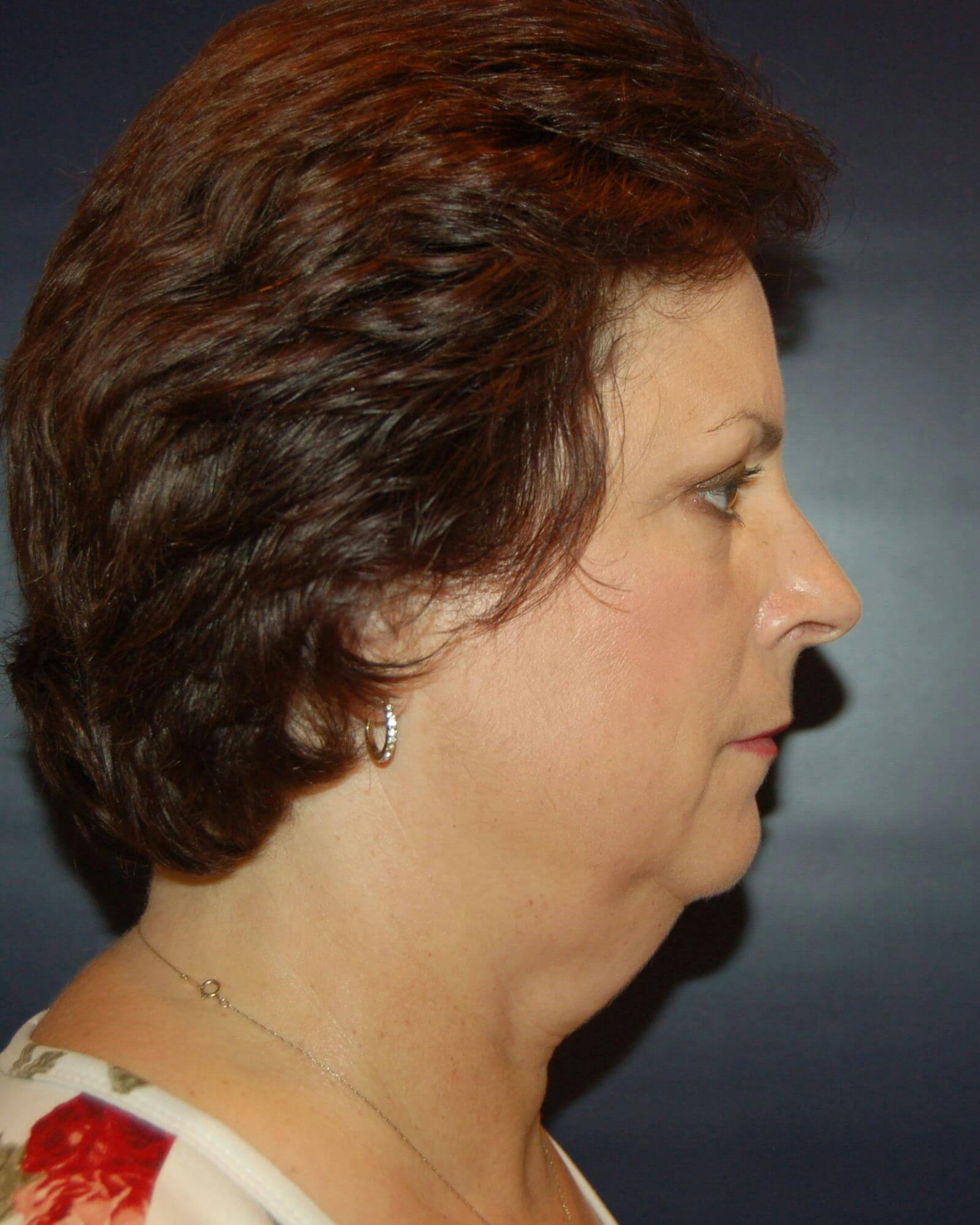Neck Liposuction Before & After Gallery - Patient 819680 - Image 1