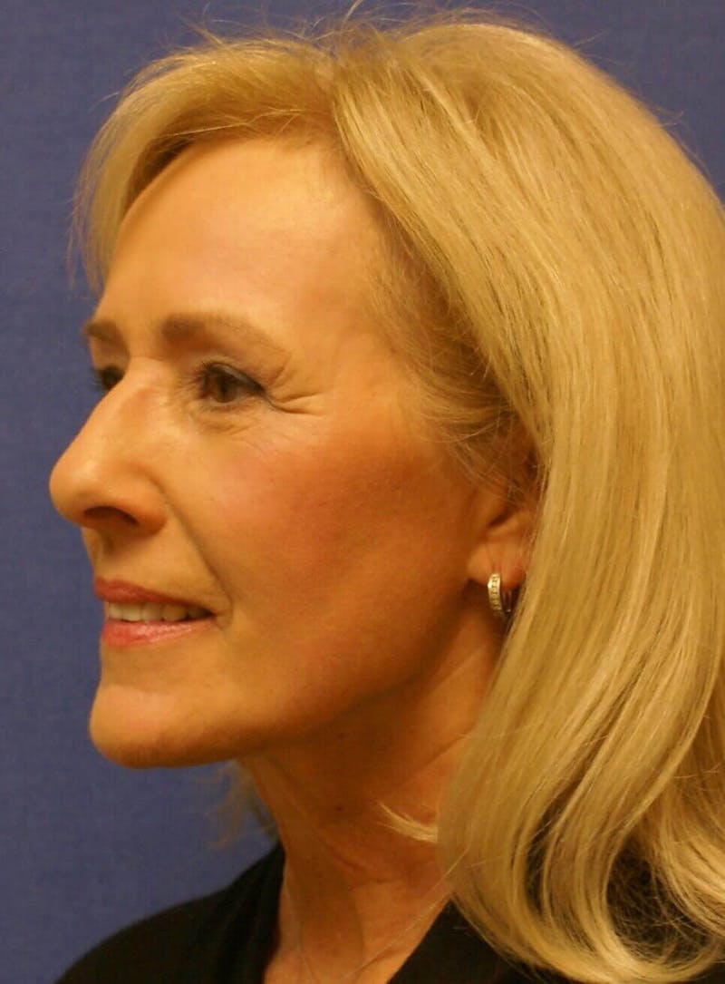 Laser Skin Resurfacing Before & After Gallery - Patient 185936 - Image 4