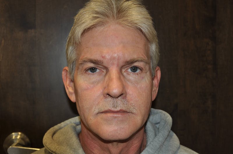 Eyelid Surgery Before & After Gallery - Patient 370575 - Image 5